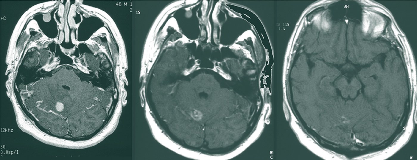 metastase_hirn