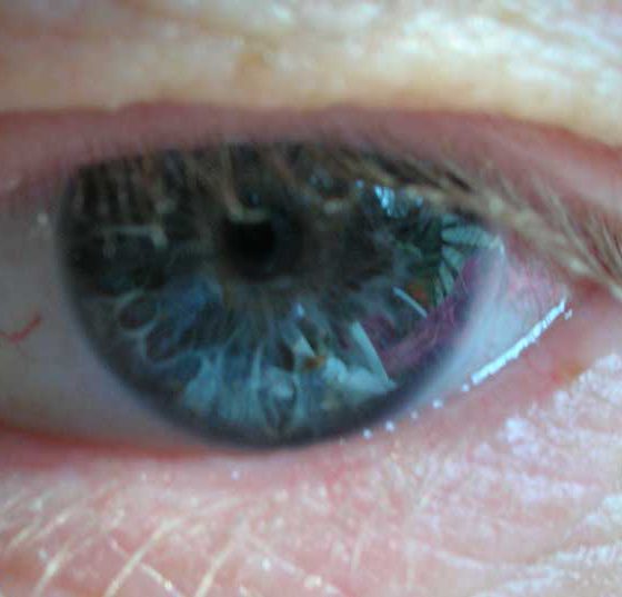 auge