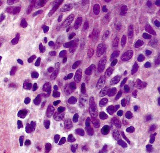 micosis_fungoides_wikimedia