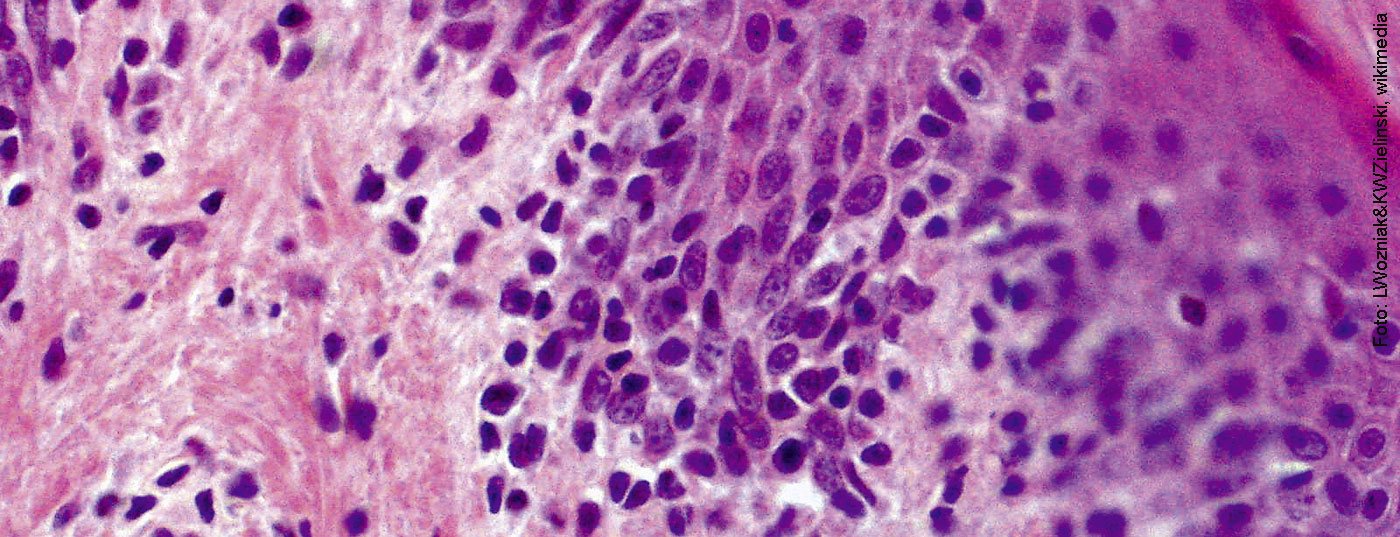 micosis_fungoides_wikimedia