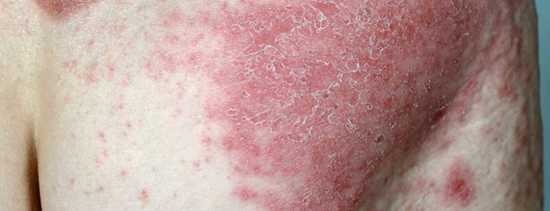 psoriasis2
