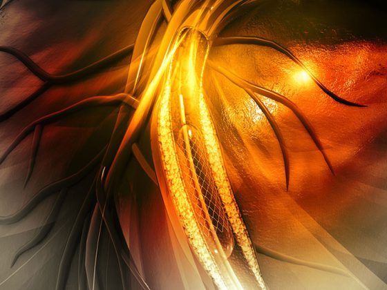 stent_istock-475746604