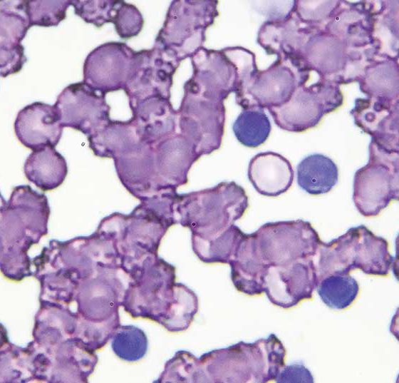 cll_leukaemie_istock-966964984