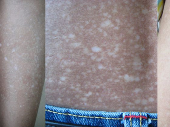 amyloidosis_cutis_dyschromica