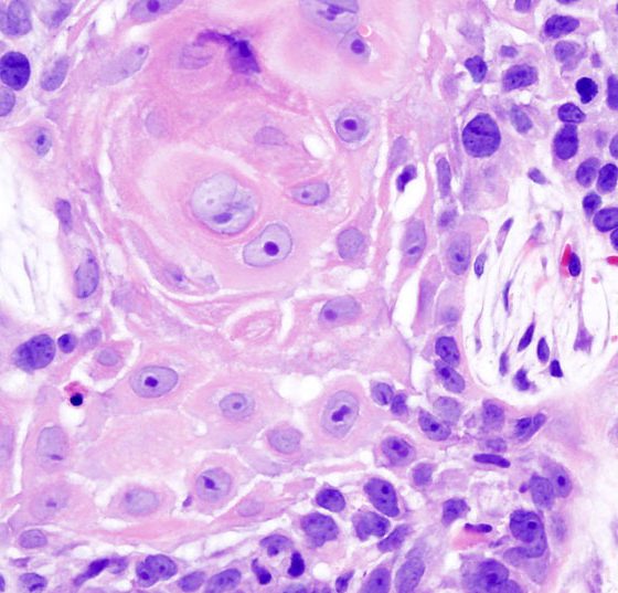 oral_cancer_1_squamous_cell_carcinoma_histopathology