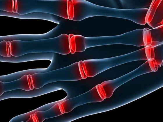 arthritis