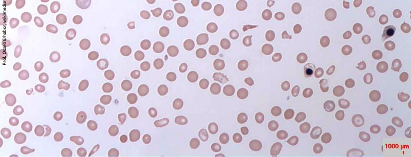 blutarmut_haemolytic_anaemia