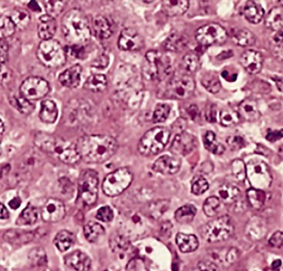 lymphoepithelioma_met_to_ln_6
