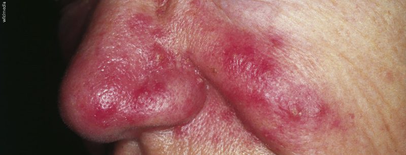 rosacea_wikimedia