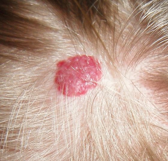 hemangioma