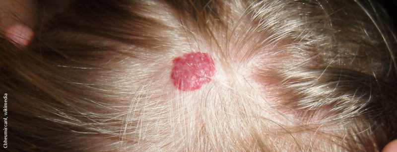 hemangioma