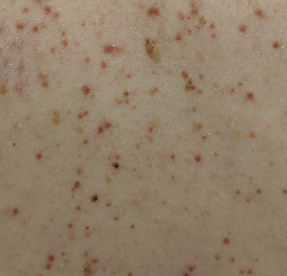 mastocytosis2019