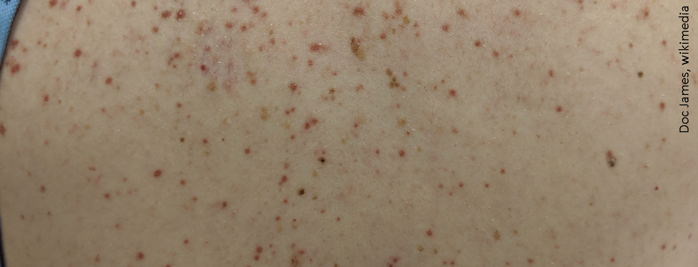 mastocytosis2019
