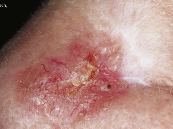 hautkrebs-hell_scar-like_morphea-like_bcc