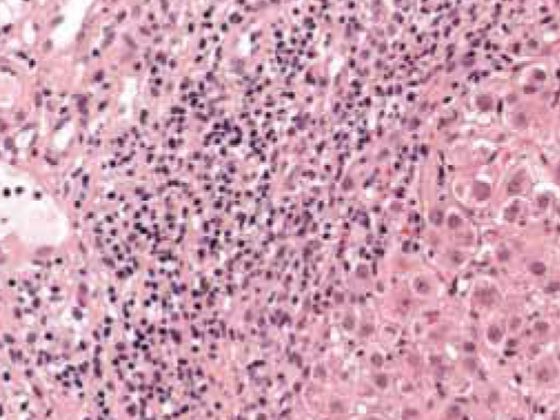 hepatitis