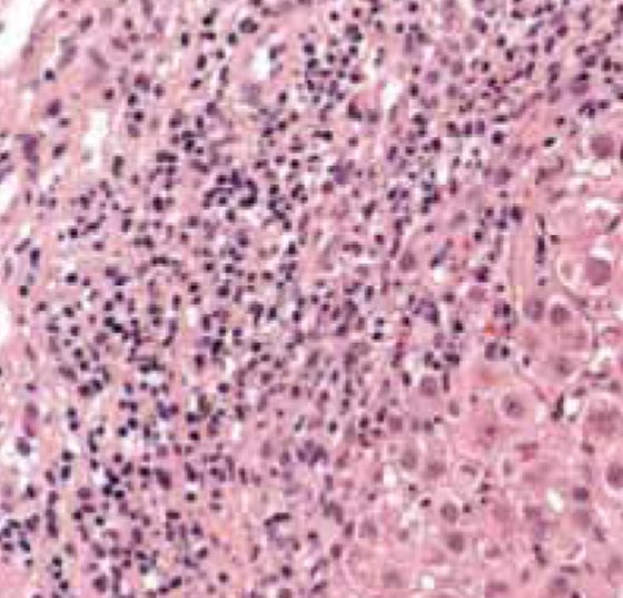 hepatitis