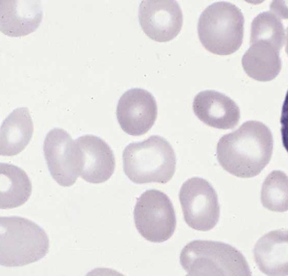 polycythemia_vera_blood_smear