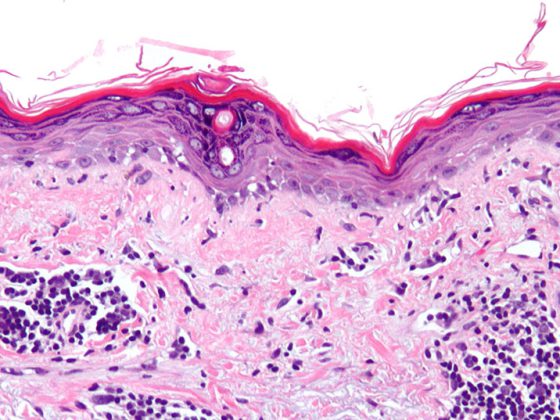lupus_sle