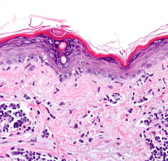 lupus_sle