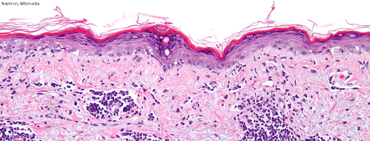 lupus_sle