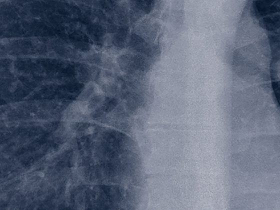sarkoidose_lunge