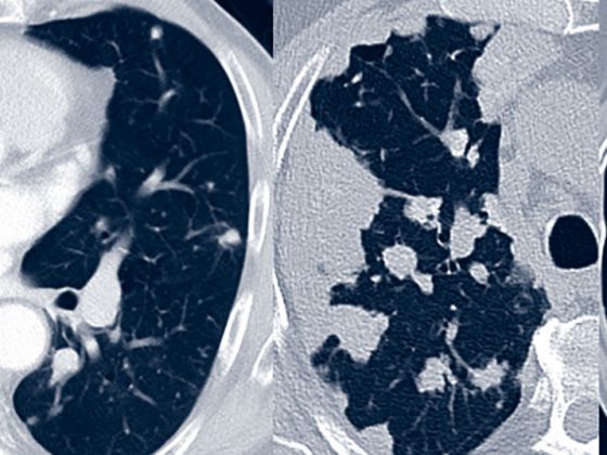 amyloidose_pulmonal