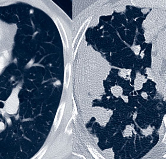 amyloidose_pulmonal