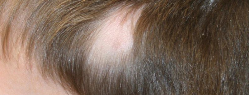 alopecia_dp4
