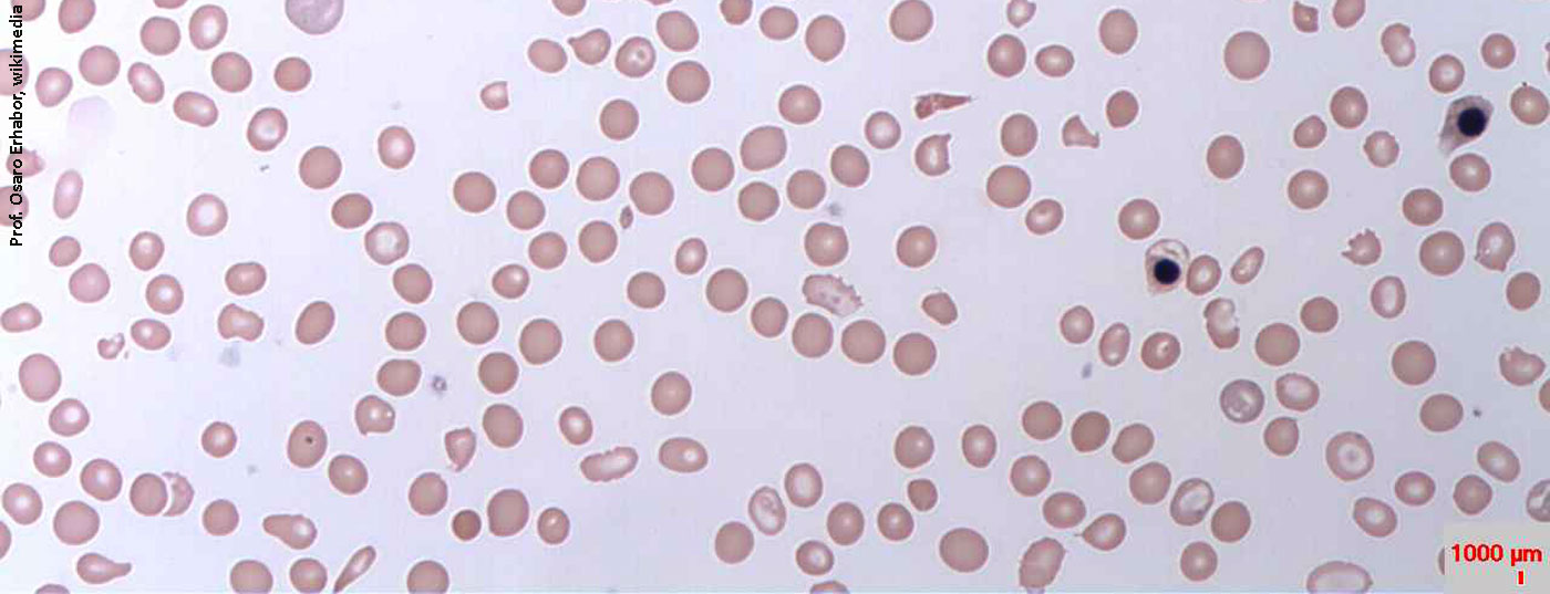 blutarmut_haemolytic_anaemia