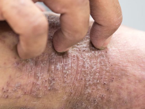 juckreiz_atopderma_istock-868935944