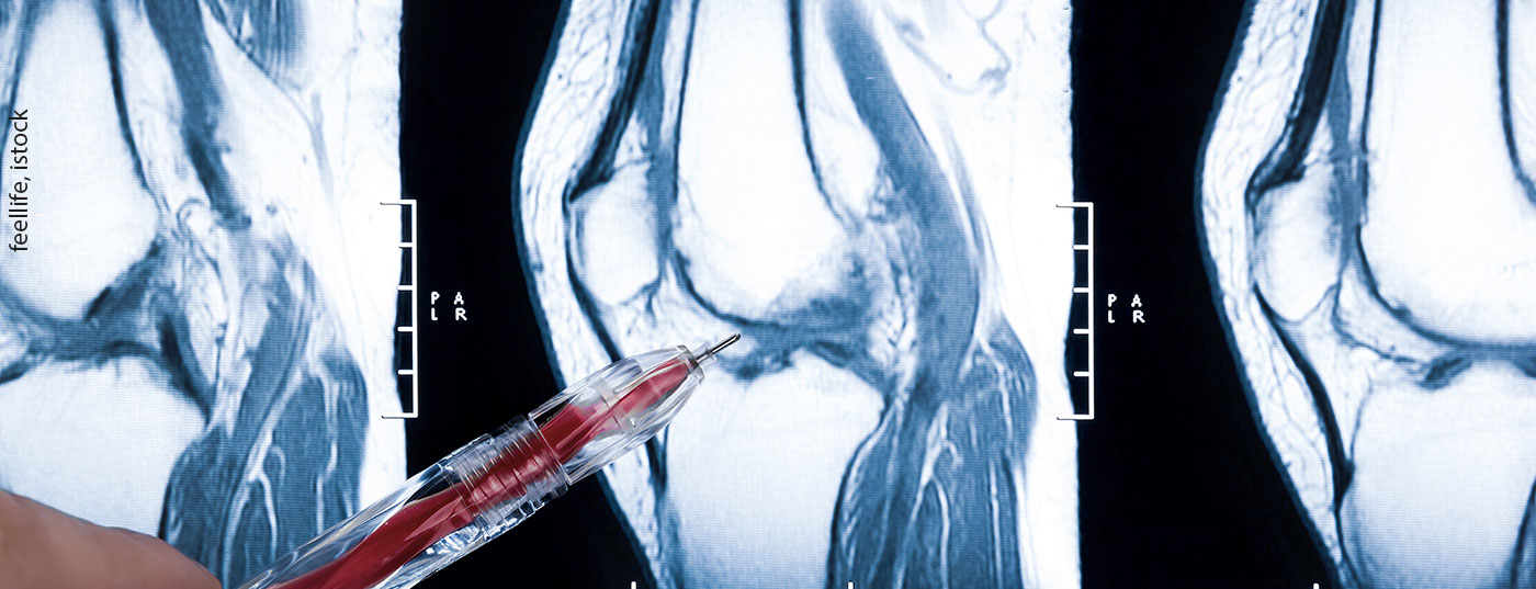 knie_istock-162258590