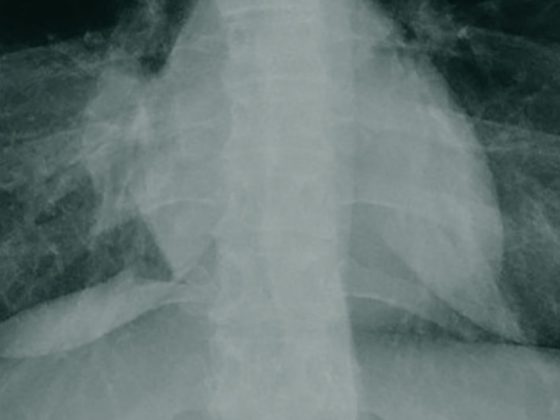 pancoast_tumor