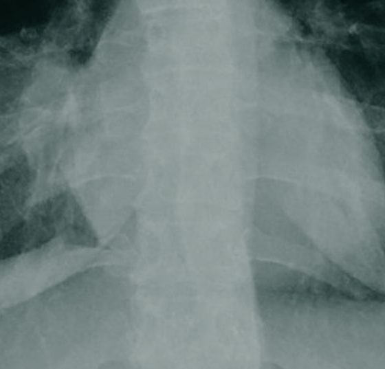 pancoast_tumor