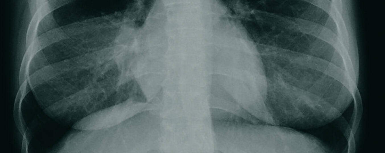 pancoast_tumor