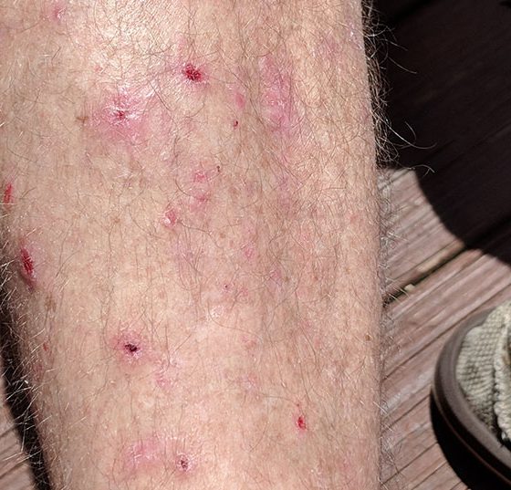 pemphigoid
