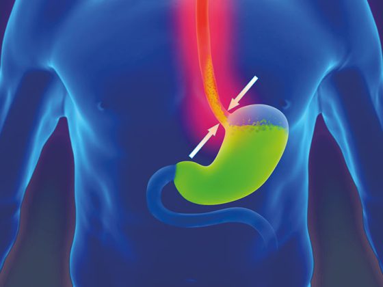 reflux
