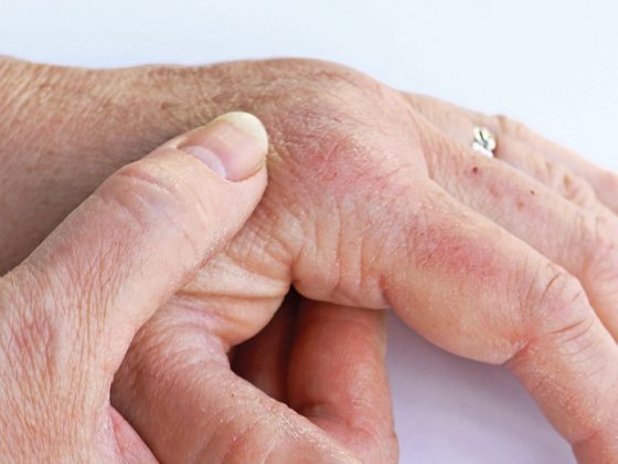 psoarthritis_istock-684565114