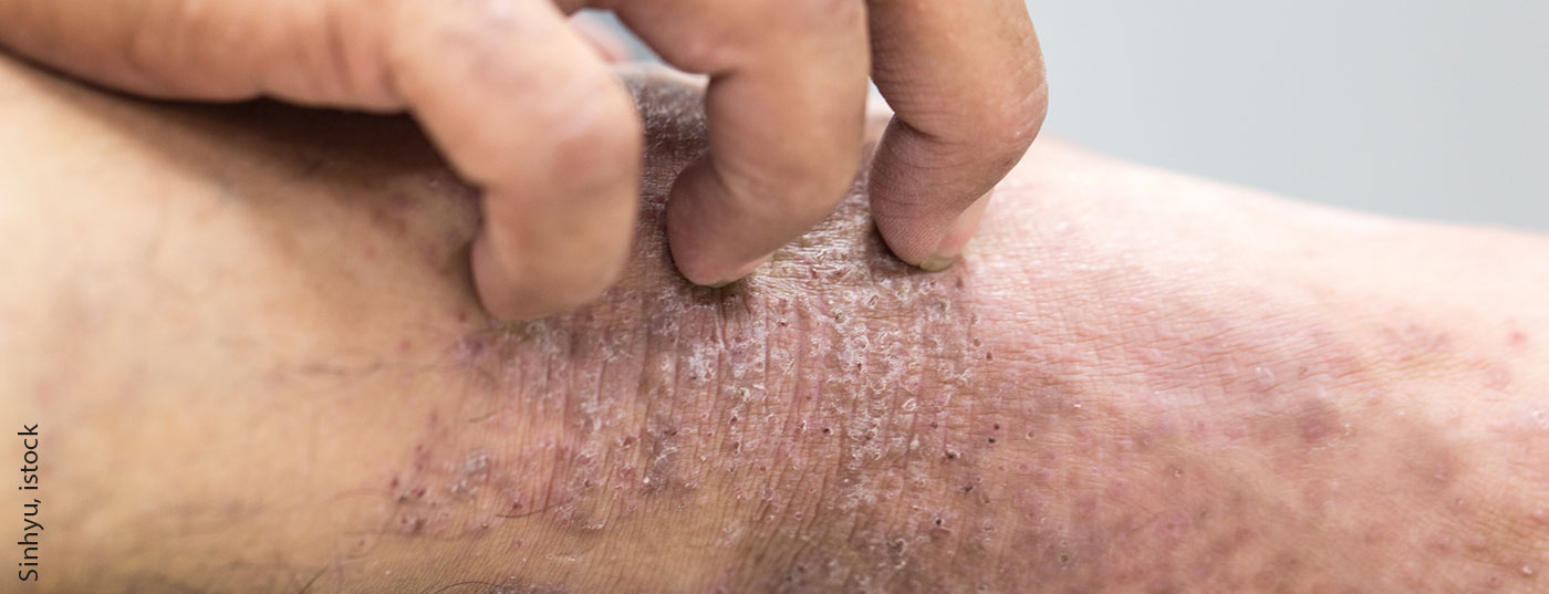 juckreiz_atopderma_istock-868935944