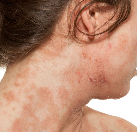 atopische_derma_istock-165665917