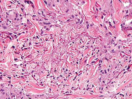 granuloma_anulare