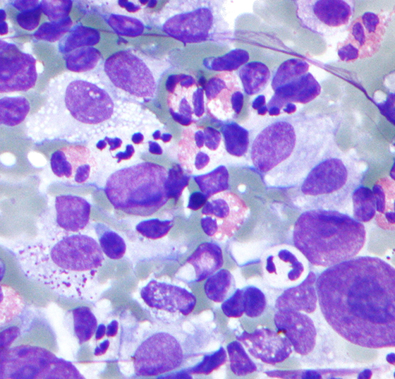 hodgkin_lymphoma_cytology_large