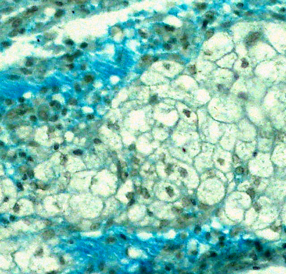 mycosisfungoides