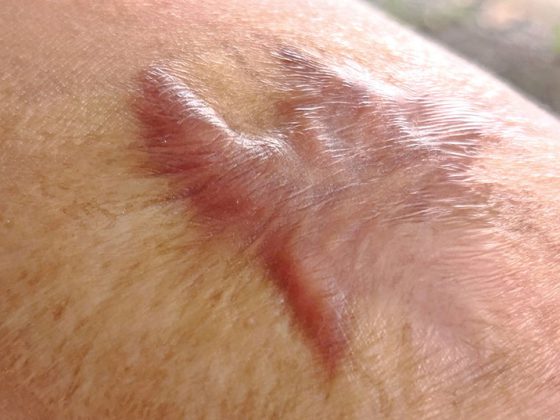 keloid_istock-1001378268