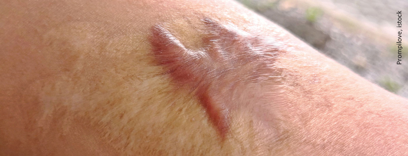 keloid_istock-1001378268