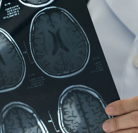 gehirn_mri_ct-scan_istock-862563174