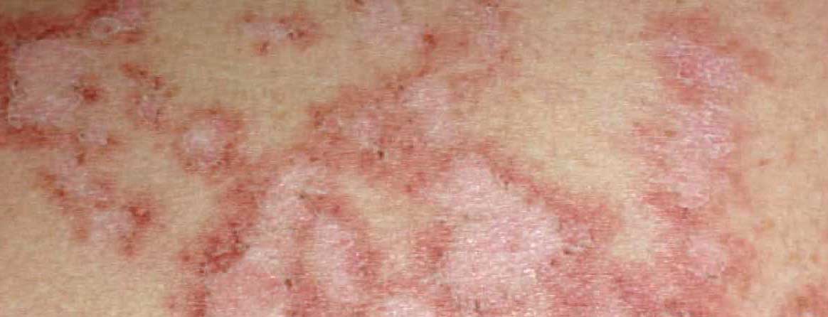 lupus_syndrom