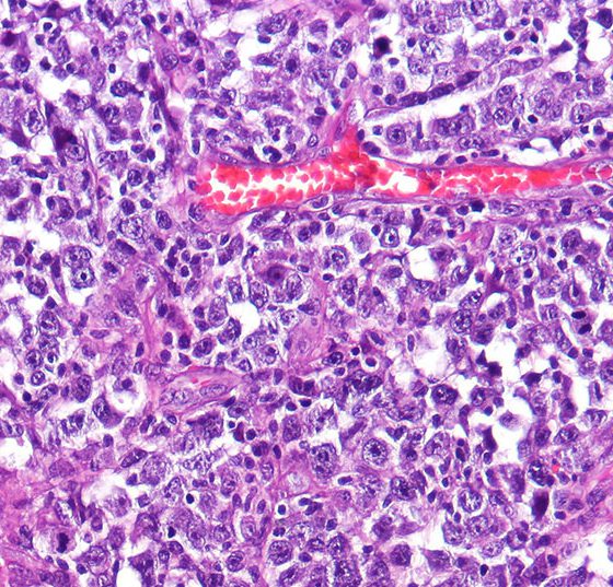 diffuse_large_b-cell_lymphoma_dlbcl_high_mag