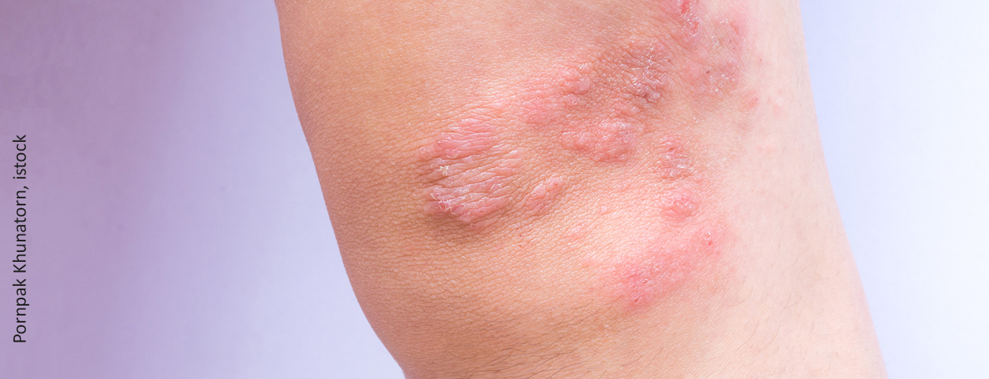 atopische_derma_istock-1170007607