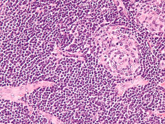 castleman_disease_-_high_mag