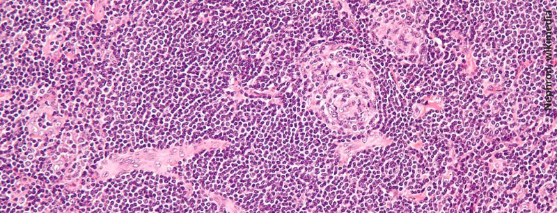 castleman_disease_-_high_mag